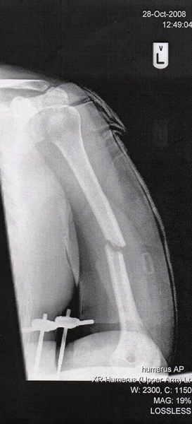 Completely Snapped Humerus Bone